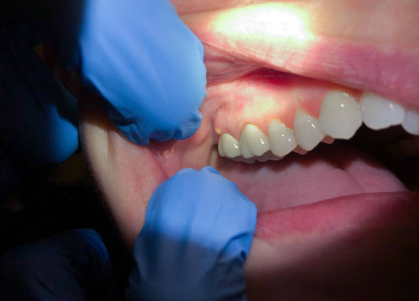 Best Emergency Treatment for Toothache in Potterville, MI