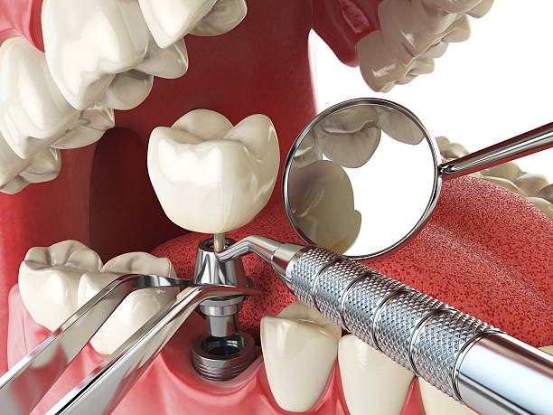 Best Emergency Treatment for Toothache in Potterville, MI